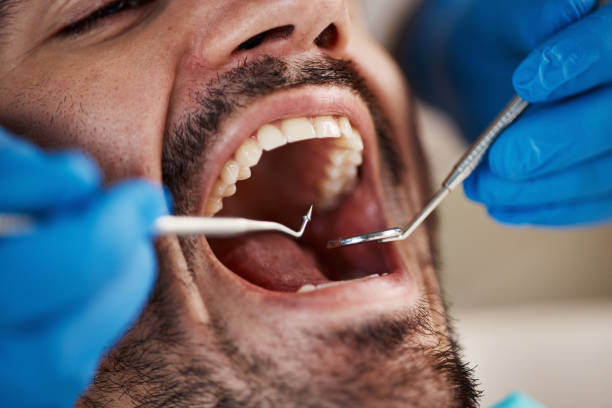 Best Emergency Wisdom Teeth Removal in Glenwood, IA